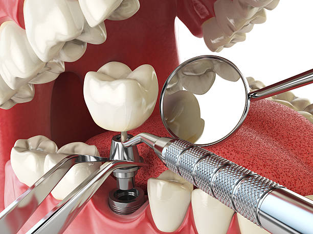 Best Broken or Cracked Tooth Emergency Dentist in Ammon, ID